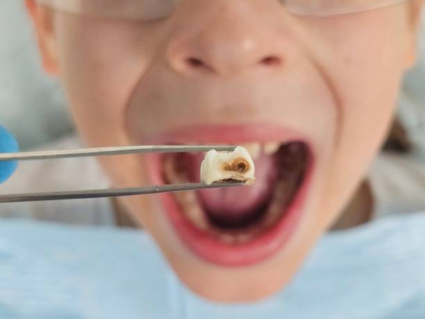 Best Emergency Wisdom Teeth Removal in Blanding, UT